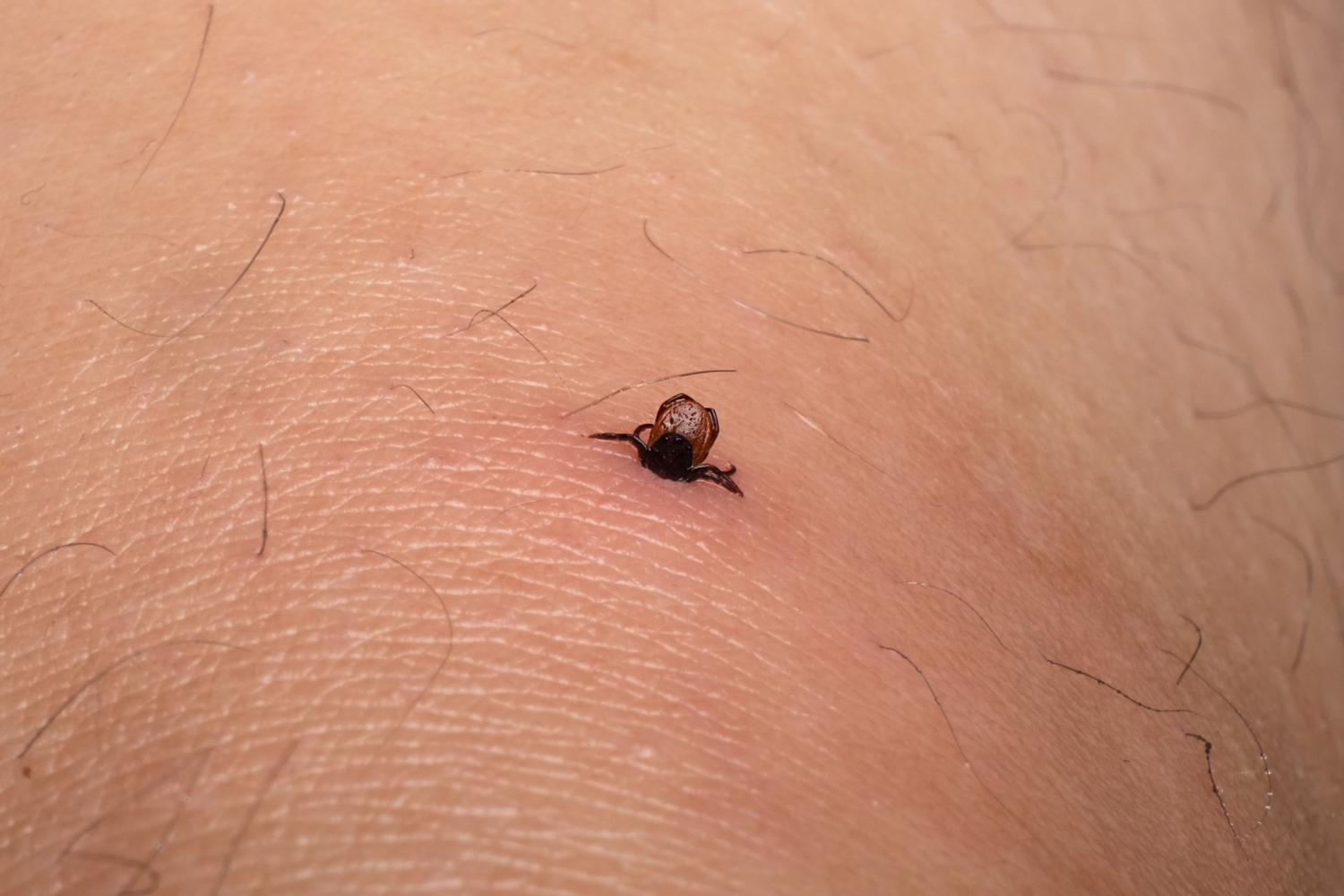 lyme disease
