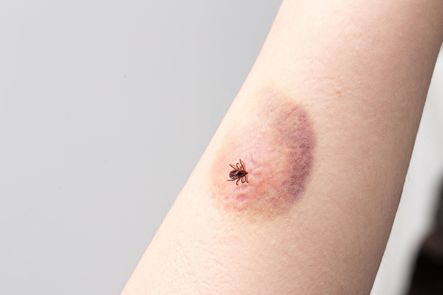 lyme disease