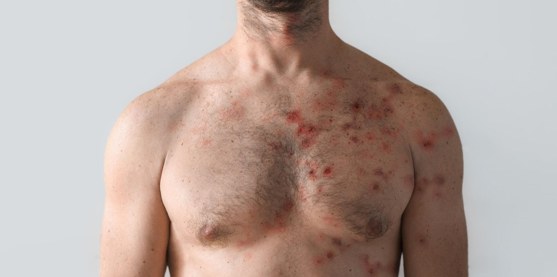 Lyme Disease